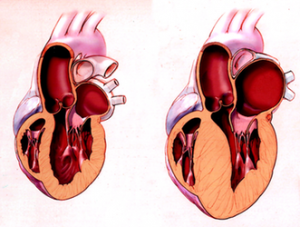 Heart hypertrophy and its Cause