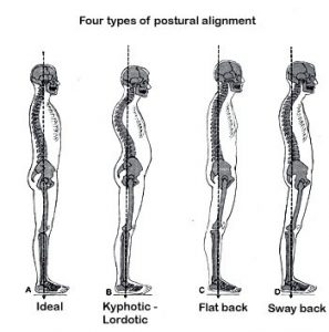 back kyphosis
