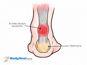 Achilles tendonitis: