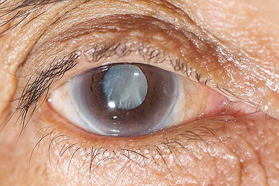  درمان آب مروارید با قطره چشم