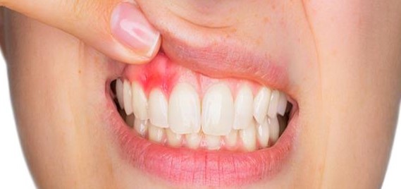 نشانه های عفونت دندان