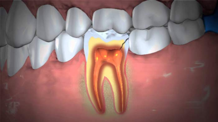 نشانه های عفونت دندان