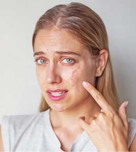 Overcome pimples and acne on the face