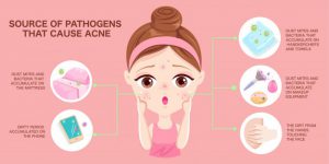 What are the causes of acne?