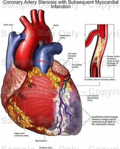 What causes myocardial infarction?