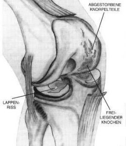 Knee abrasion (osteoarthritis)