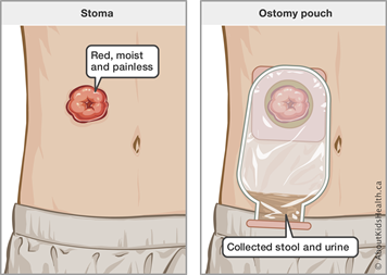 Ostomy surgery