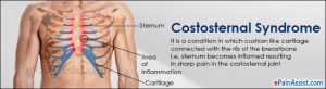 Costosternal syndrome