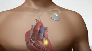 Heart pacemakers