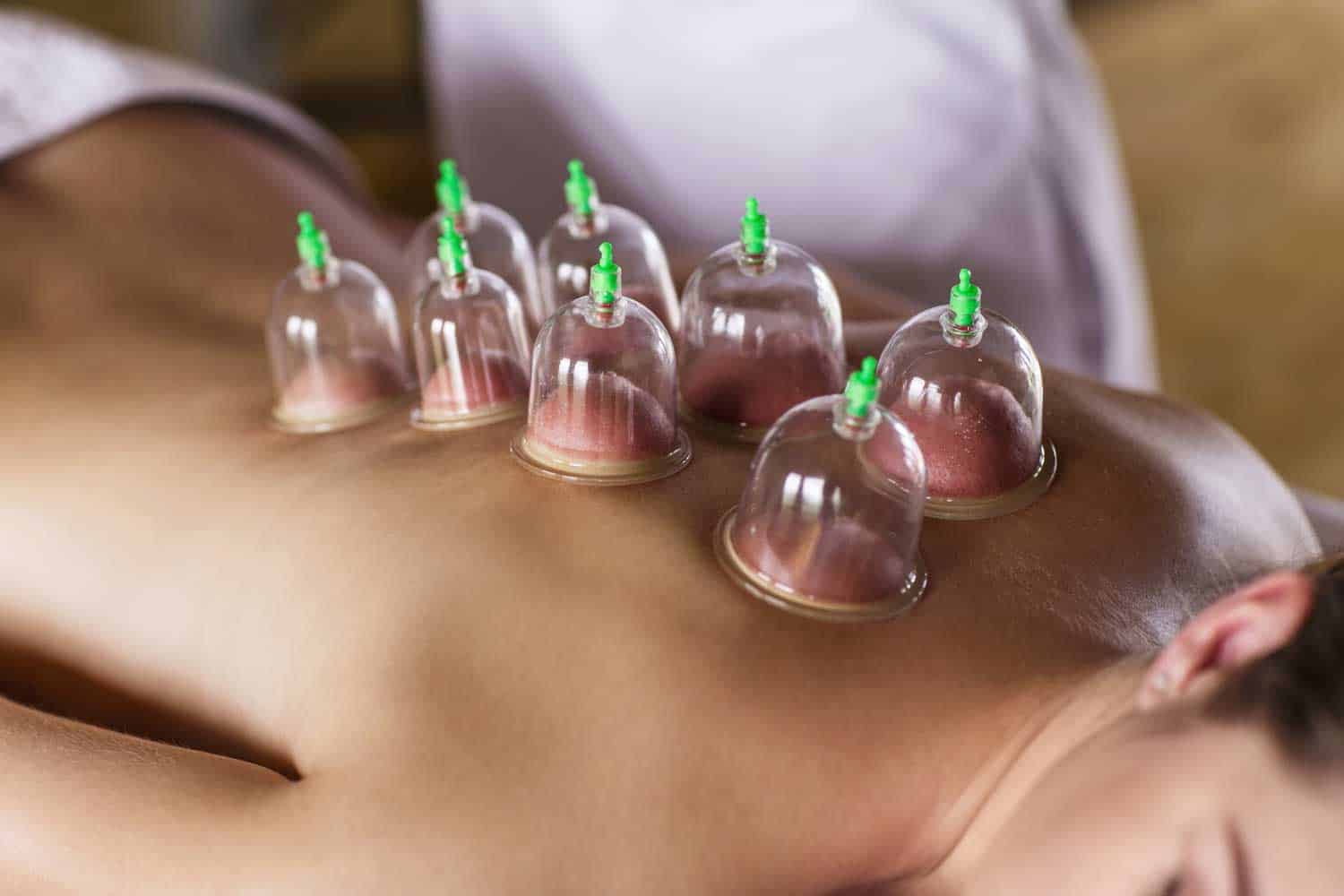 The benefits of cupping