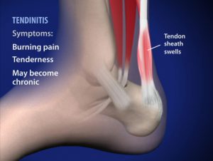 Inflammation of the Achilles tendon