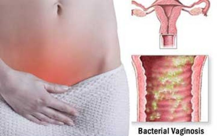 درمان های خانگی واژنوز باکتریایی