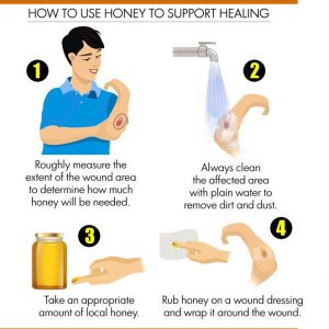 Wound healing with honey