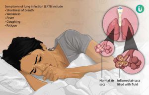Treatment of lung infection