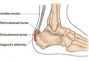 Achilles tendon bursitis