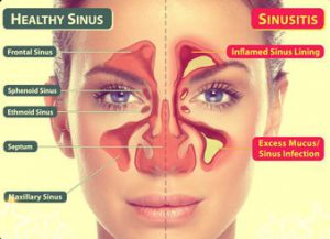 2. Sinus infection