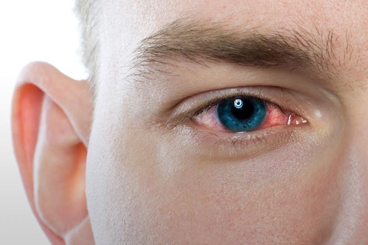 انواع عفونت چشم