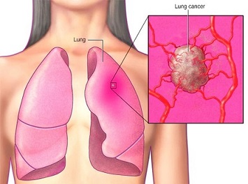 علائم سرطان ریه در زنان چیست؟