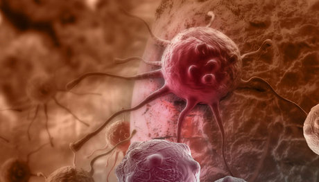 سرطان خون سلول مویی