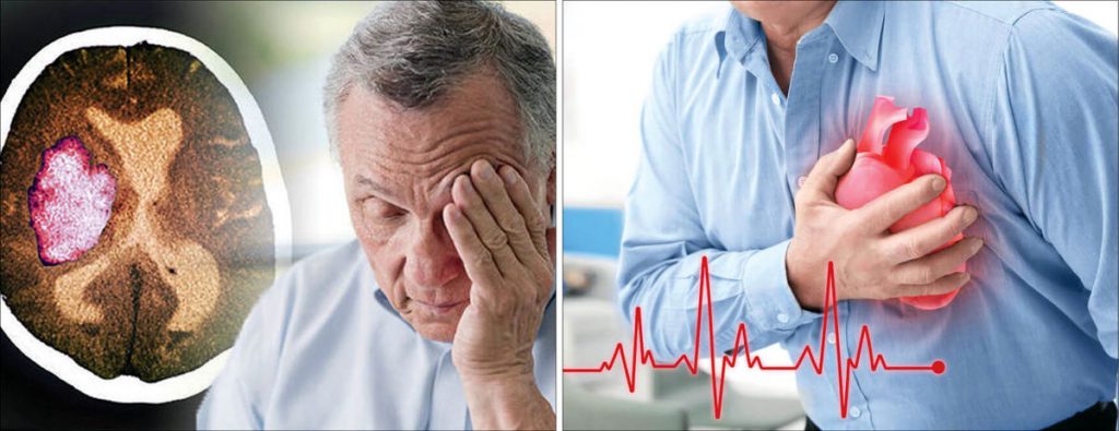 تفاوت علایم سکته مغزی و حمله قلبی