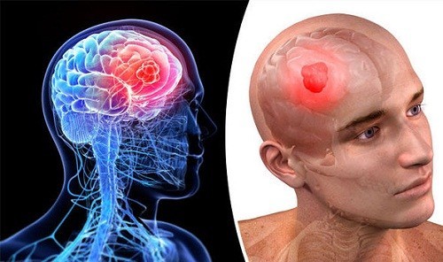 تومور مغزی غیر سرطانی