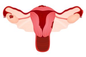 بیماری آندومتریوز (endometriosis) چیست؟ بافت آندومتر چیست؟